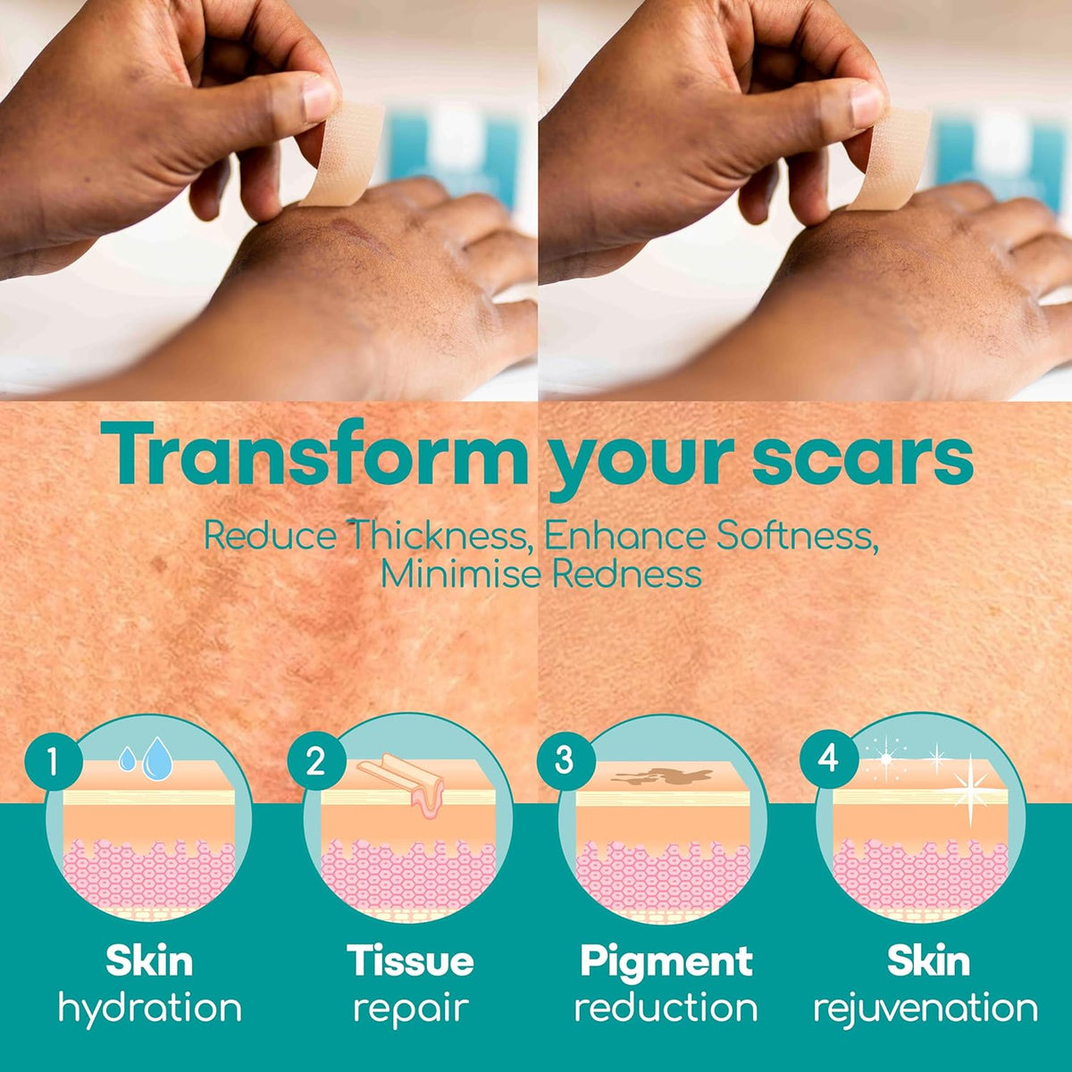 Silicone Scar Sheets, 80 Inches Long - Reusable Silicone Scar Tape - Includes Hygienic Storage Case S834